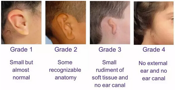 或称为先天性外中耳畸形,表现为重度耳廓发育不全,有外耳道闭锁或狭窄